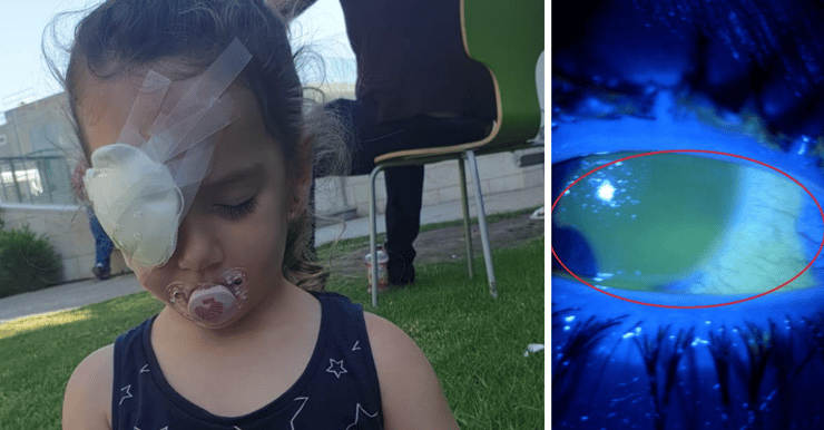מימין: הקרנית הפגועה, יובל כרמי בת ה-3