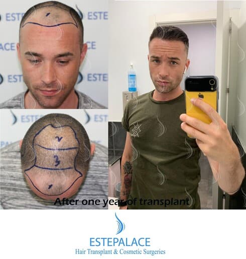 השתלת שיער