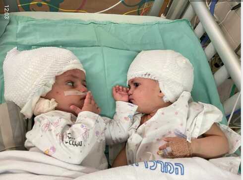 התאומות שהופרדו בסורוקה