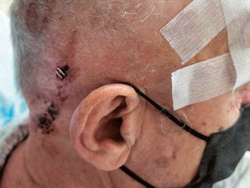 שברים בגולגולת וחתך בגבה. ניסים שקד בבית החולים 