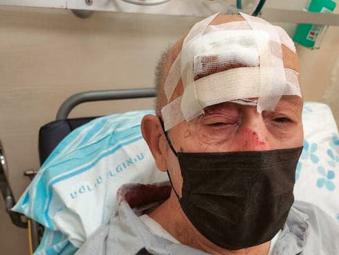 שברים בגולגולת וחתך בגבה. ניסים שקד בבית החולים רמב"ם