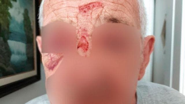 "נפצע בגללם". החבלות בפניו של אביו של כץ "נפצע בגללם". החבלות בפניו של אביו של כץ