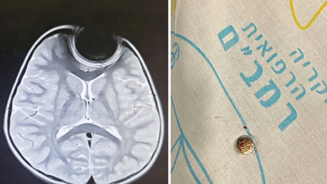 הסוללה שהוצאה, וההפרעה המגנטית בראש צילום הדימות שנגרם מהסוללה (צילום: קריה רפואית רמב"ם) הסוללה שהוצאה, וההפרעה המגנטית בראש צילום הדימות שנגרם מהסוללה