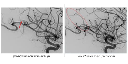 קריש הדם שהתגלה בראשו של מאיר