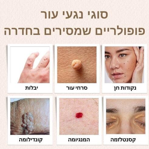 סוגי נגעי עור פופולריים שמסירים בחדרה (צילום: יח"צ ) סוגי נגעי עור פופולריים שמסירים בחדרה