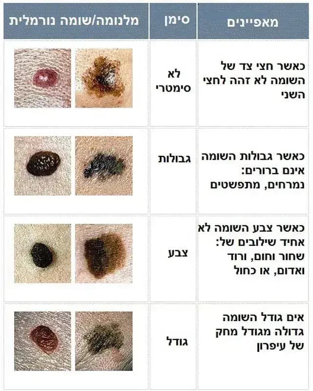 סימנים מחשידים לשומות (צילום: יח"צ) סימנים מחשידים לשומות