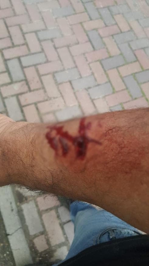 הפציעה ביד של גיורא לוי. צילום: באדיבותו