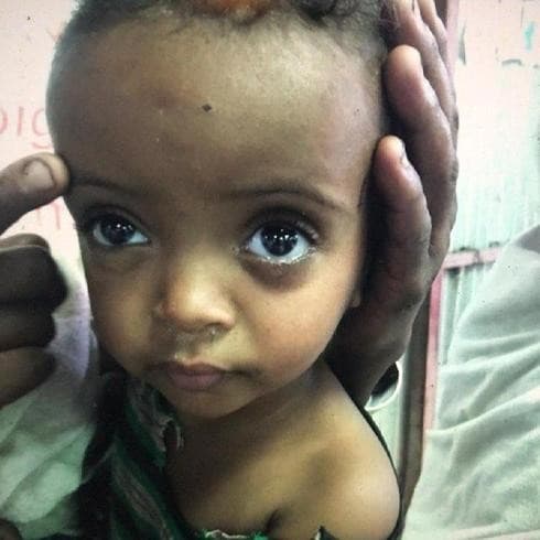 "Hay niños con la cabeza demasiado grande y brazos delgados como mondadientes". (Cortesía del doctor Harstein) "Hay niños con la cabeza demasiado grande y brazos delgados como mondadientes".