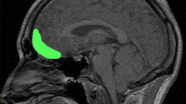 El cerebro psicopático.