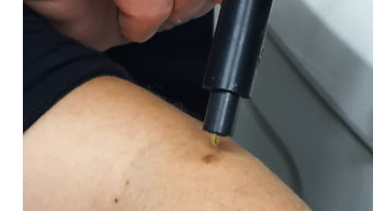 El dispositivo permite distinguir sustancias malignas a partir de su "color" en el espectro infrarrojo. 
