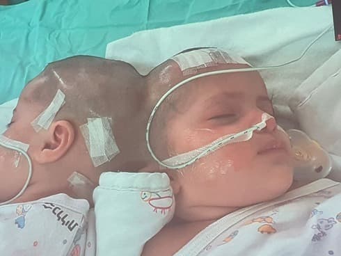 Las hermanas antes de la operación.