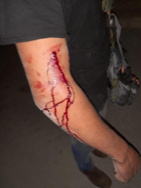 El brazo herido de uno de los hermanos. 