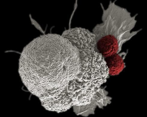 Tumor canceroso atacado por dos células T. 