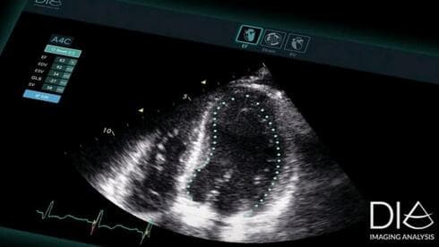 Soluciones de software basadas en IA para ecografía cardiaca.