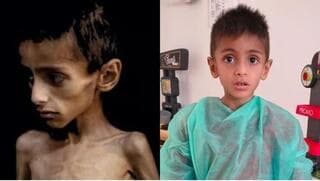 El niño sufre de fibrosis quística y fue evacuado a Italia. 