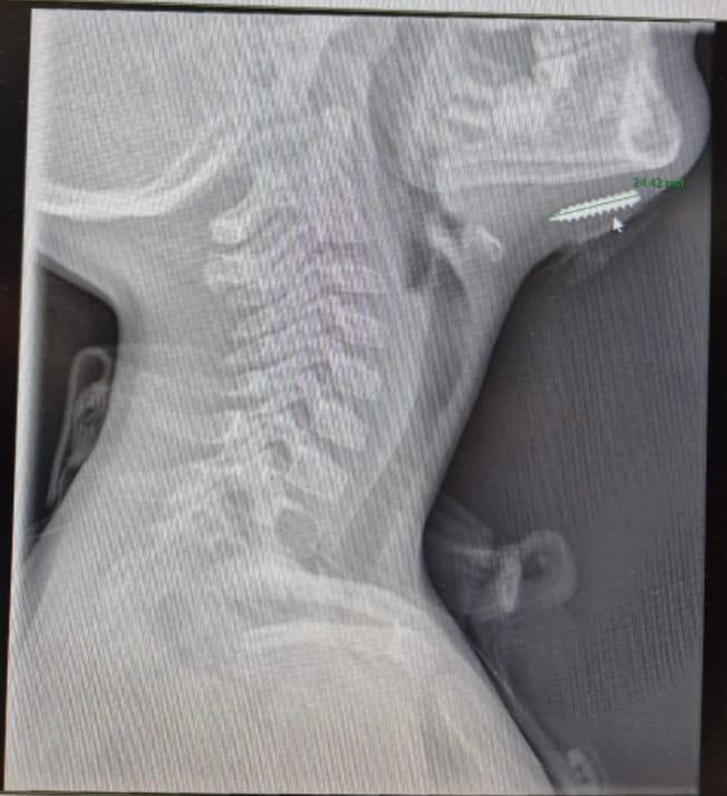 دراما طبية: برغي مغروس في ذقن طفل 