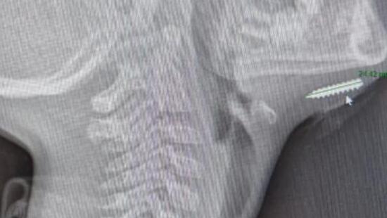 دراما طبية: برغي مغروس في ذقن طفل 