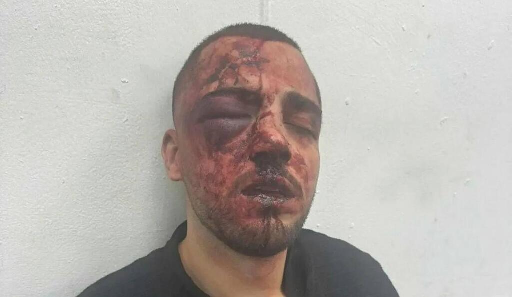 المحامي ناصر نعمة بعد اعتداء الشرطة عليه (استخدام الصورة وفقا للبند 27أ من حقوق النشر) المحامي ناصر نعمة بعد اعتداء الشرطة عليه